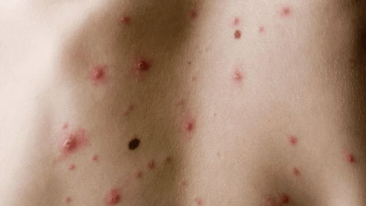 艾滋病初期皮疹症状：背部出现皮疹