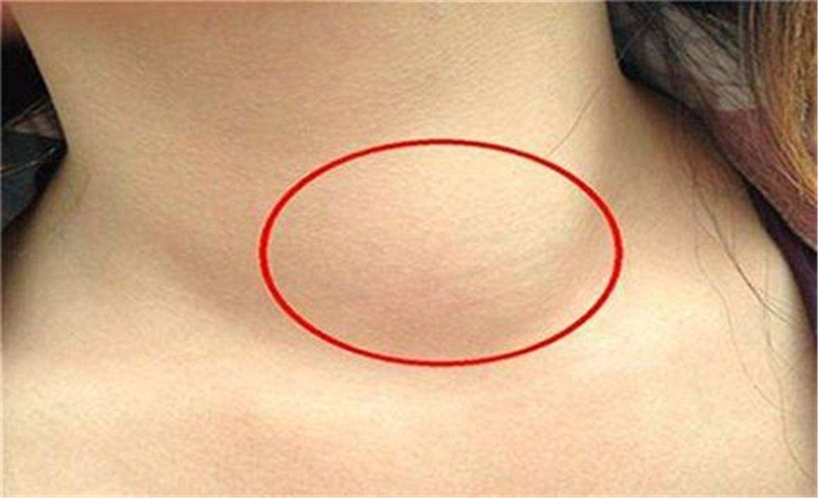 艾滋初期皮疹图片 ：出现皮疹可能伴随着淋巴结的肿大