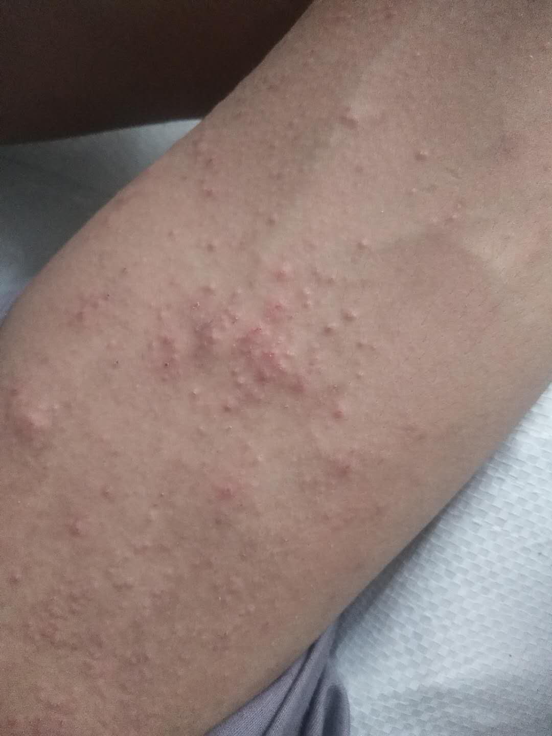 艾滋病初期皮肤图片：手臂上出现小疹子