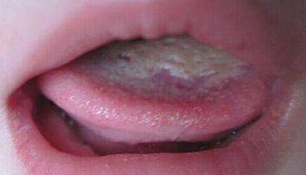艾滋病舌头图片：鹅口疮。