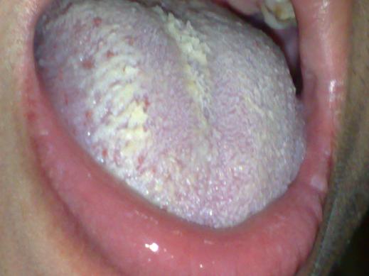 艾滋病初期表现舌头：念珠菌口腔炎