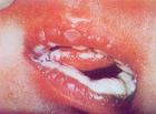 艾滋病嘴唇：口腔溃疡。