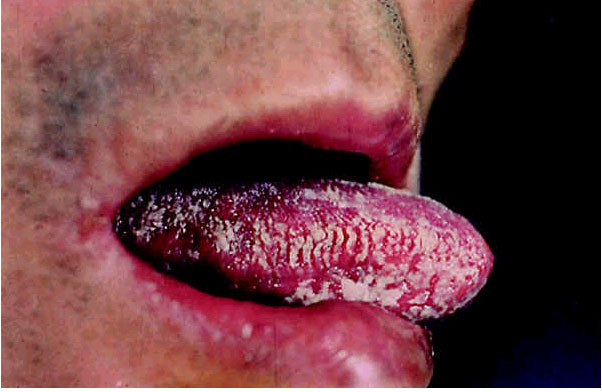 艾滋病，舌头症状：毛状白斑。