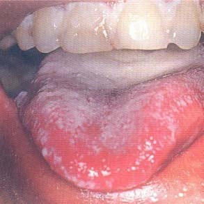 艾滋病症状图片：舌苔泛白且过厚