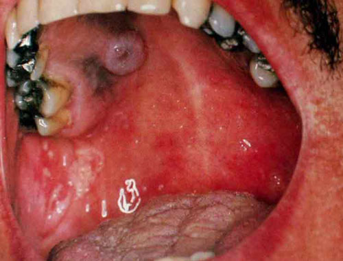 艾滋病口腔溃疡图片：舌头和上颚