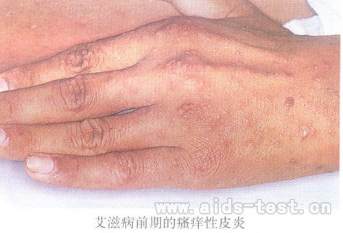 艾滋病初期症状之皮疹症状图片