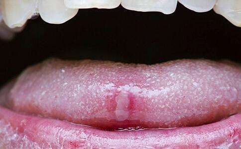 艾滋病舌头
