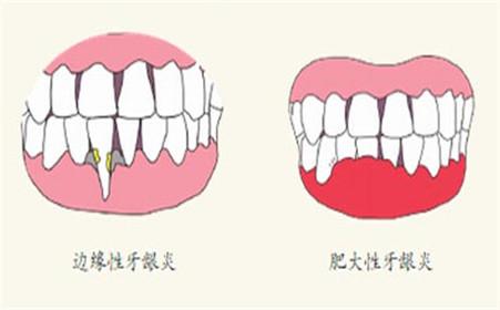 艾滋病晚期症状：牙龈炎