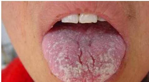 艾滋病皮肤症状及图片：口腔感染