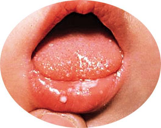舌头症状