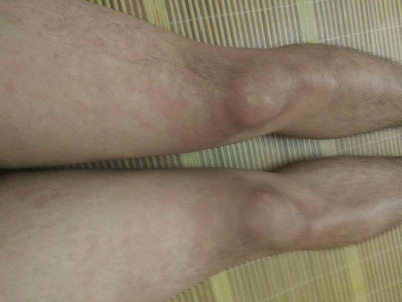 皮肤变化腿