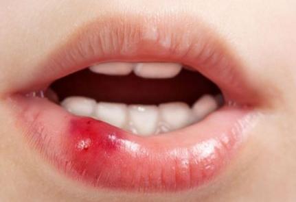 艾滋病舌头症状图片：唇周疱疹