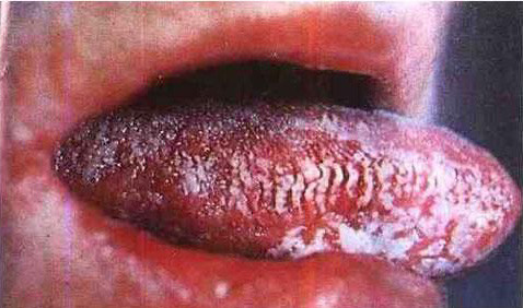 艾滋病舌头症状