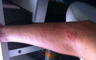 高危行为后两天检查艾滋