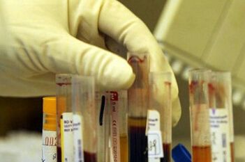 干血斑hivdna：最快的艾滋病检测手段