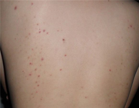 艾滋病初期症状皮疹照片 ：多见于背部