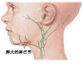 艾滋病脖子图片：淋巴结肿大大致分布位置