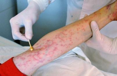 艾滋病长的疹子图片：出现疹子后遵从医嘱进行治疗