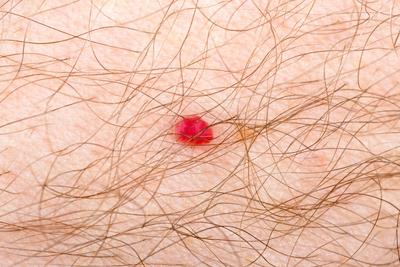 艾滋病腿上的红斑图片：腿上出现小血点