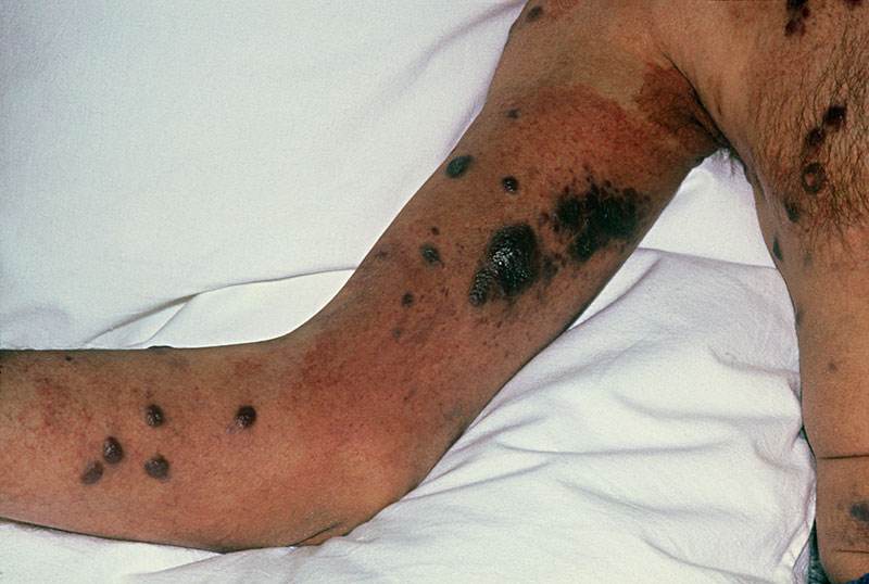 艾滋小臂疙瘩图片：晚期病变疙瘩发黑