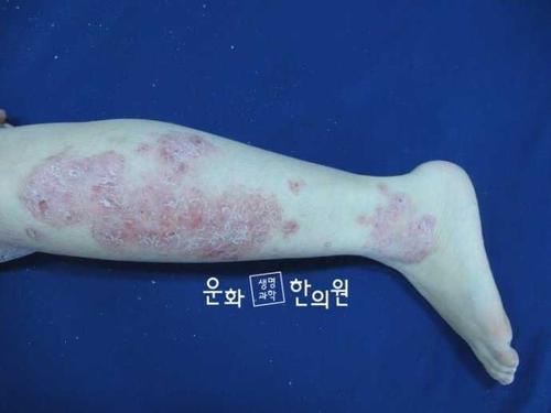 艾滋病早期长红斑图片：腿上出现红斑且出现了皮肤病变