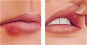 艾滋病的嘴唇起泡图片：唇周及嘴唇内部