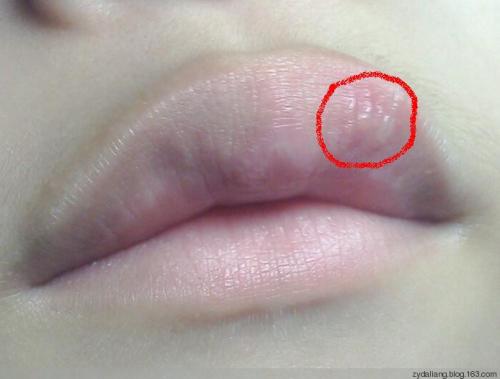 嘴唇表面起细密小疹子图片
