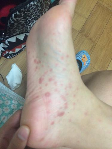 艾滋病脚红斑早期图片：脚掌