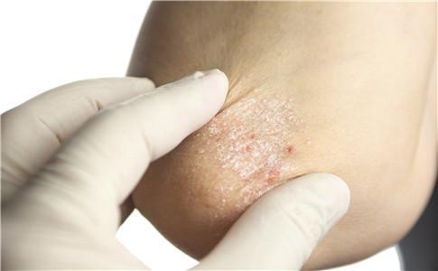 艾滋病痒疹是什么：痒疹引发多种皮肤病
