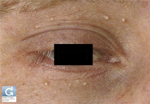 艾滋病的眼部早期症状图片