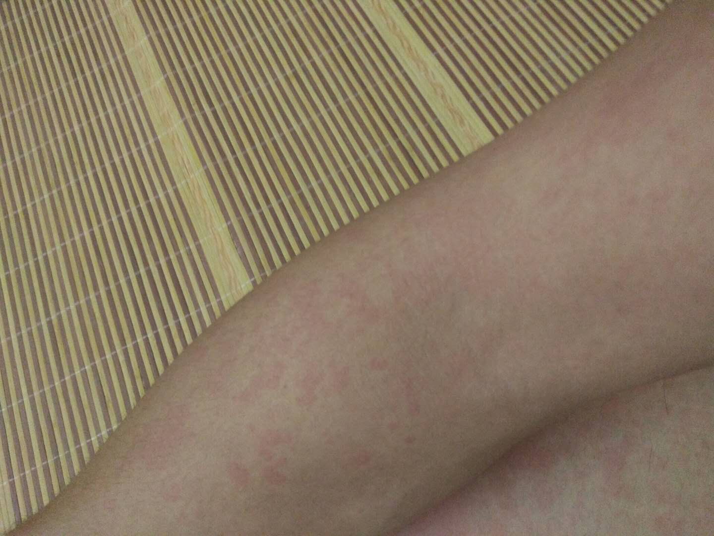 艾滋病感染者早期的皮肤皮疹症状