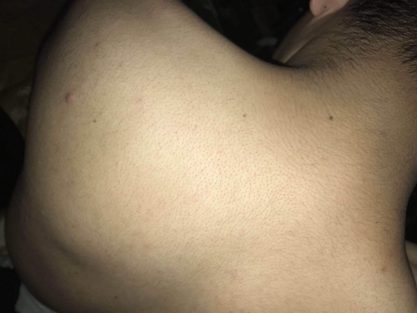 艾滋病有什么症状，小红点