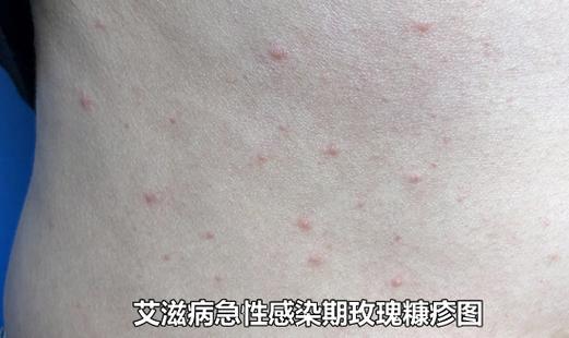 艾滋来源