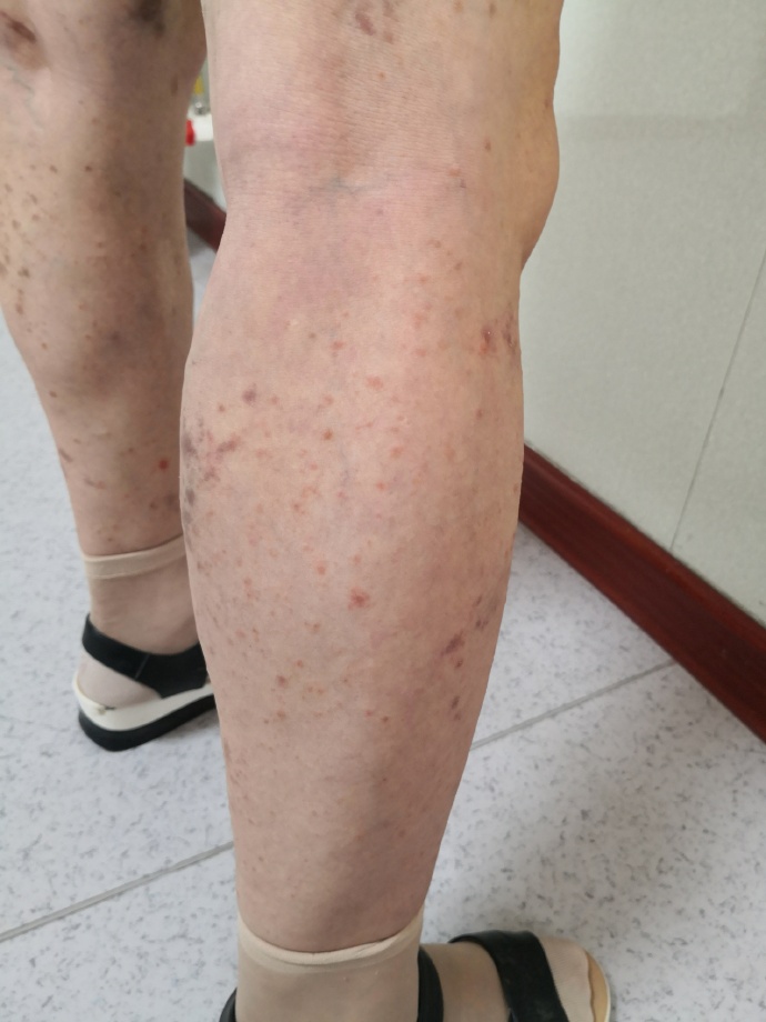 hiv病毒核酸检测多长时间