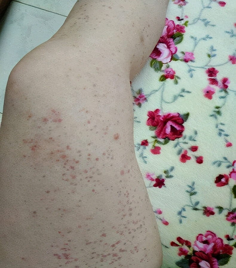艾滋病血常规