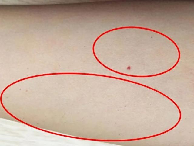 艾滋窗口期症状