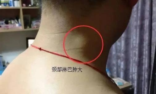 小儿艾滋治疗