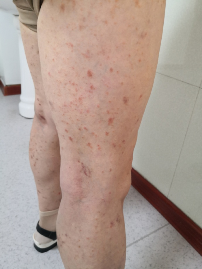 艾滋皮疹图片和普通皮疹区别
