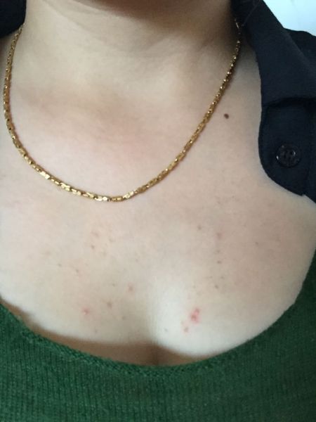 艾滋病舌苔