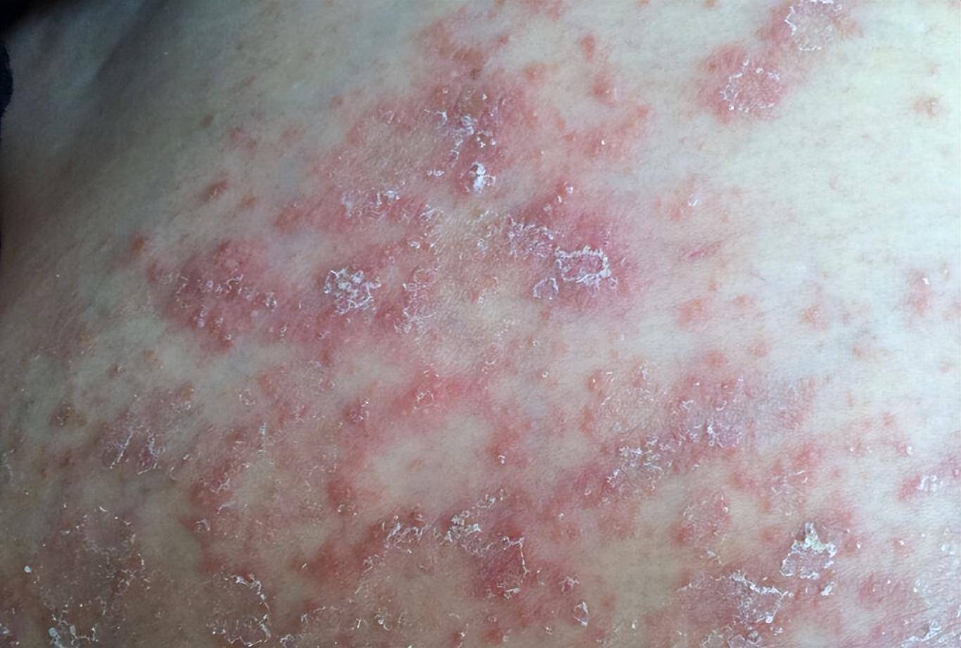 20天后hiv核酸检测正常