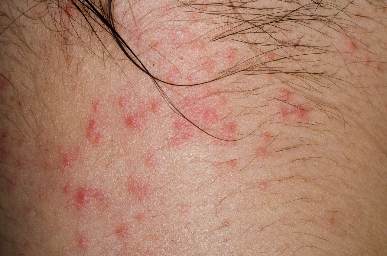 艾滋病皮疹症状