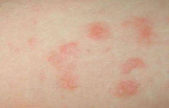 hiv核酸阳性是检测了两次吗