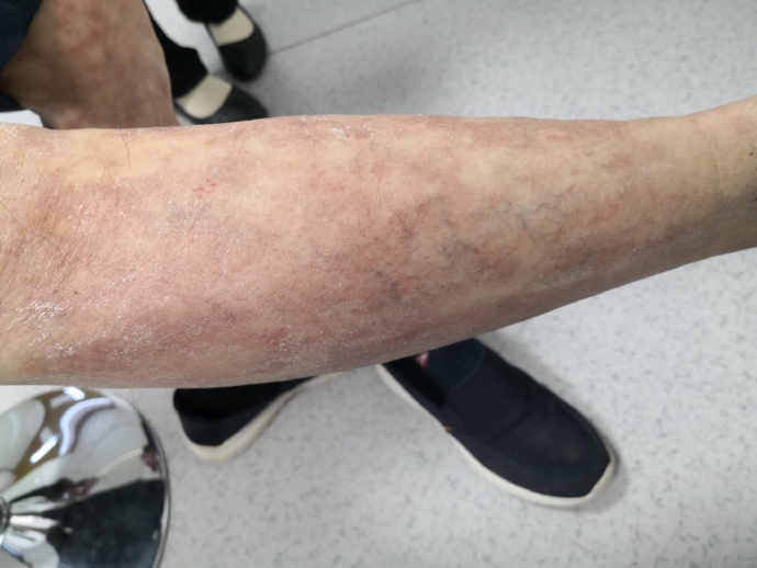 艾滋病窗口期多久排除