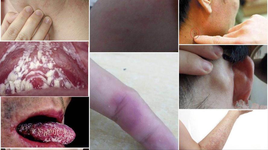 hiv核糖核酸检测是抽血吗