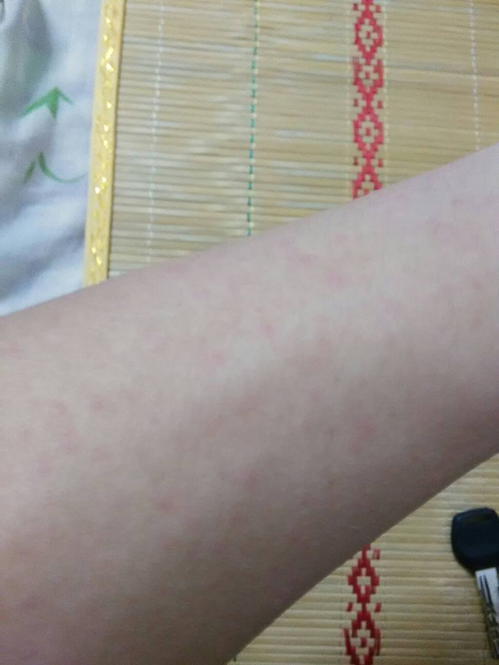 艾滋病感染初期的症状