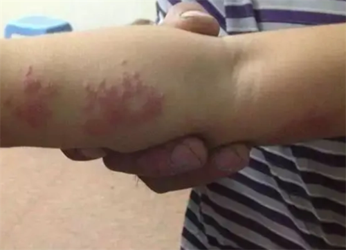 斗殴得艾滋