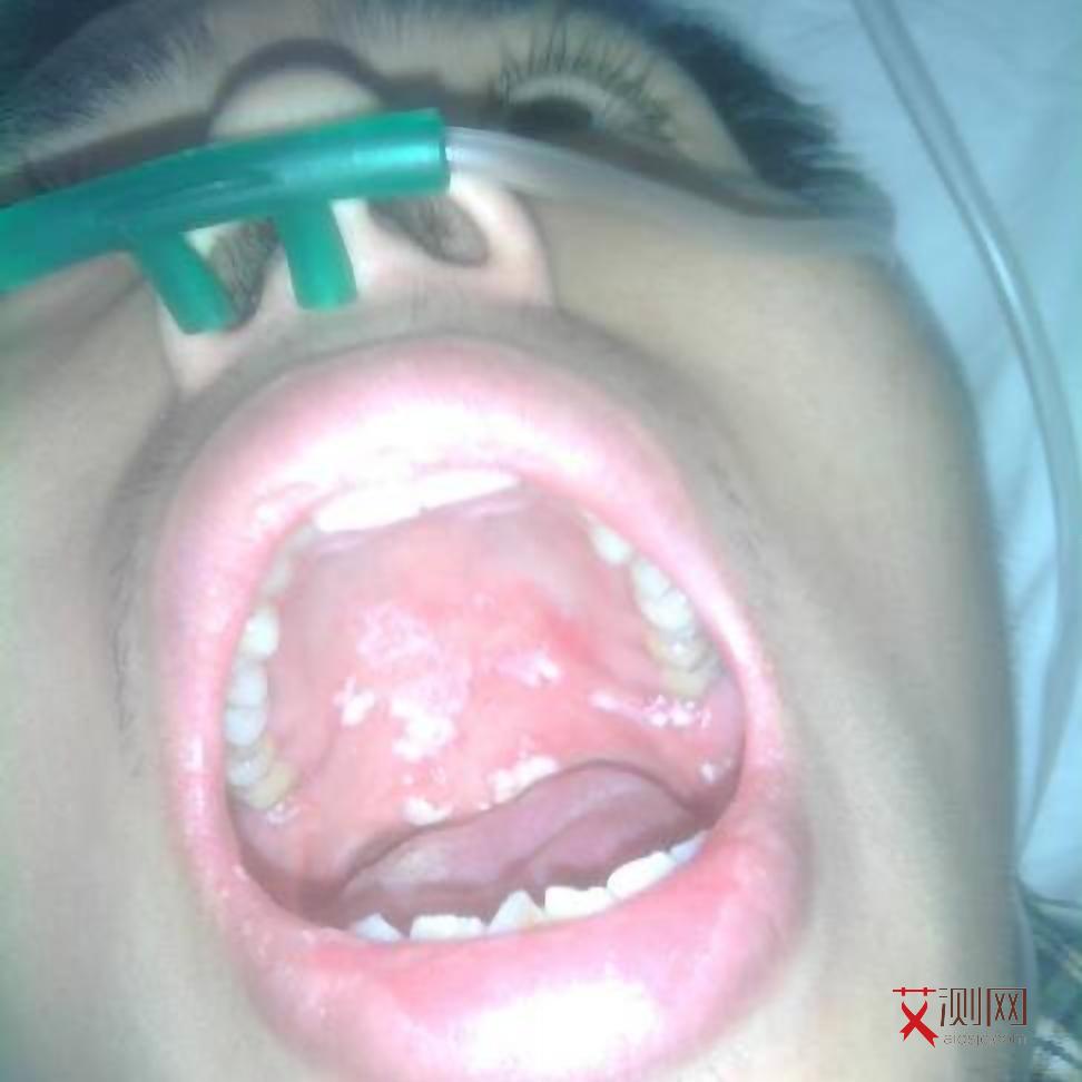 艾滋病会引起各种炎症吗图片