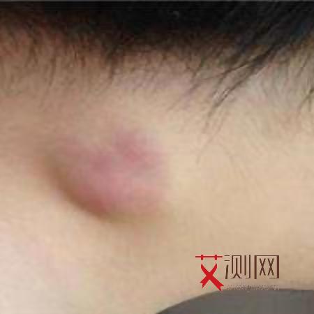 艾滋病会持续多久发烧症状