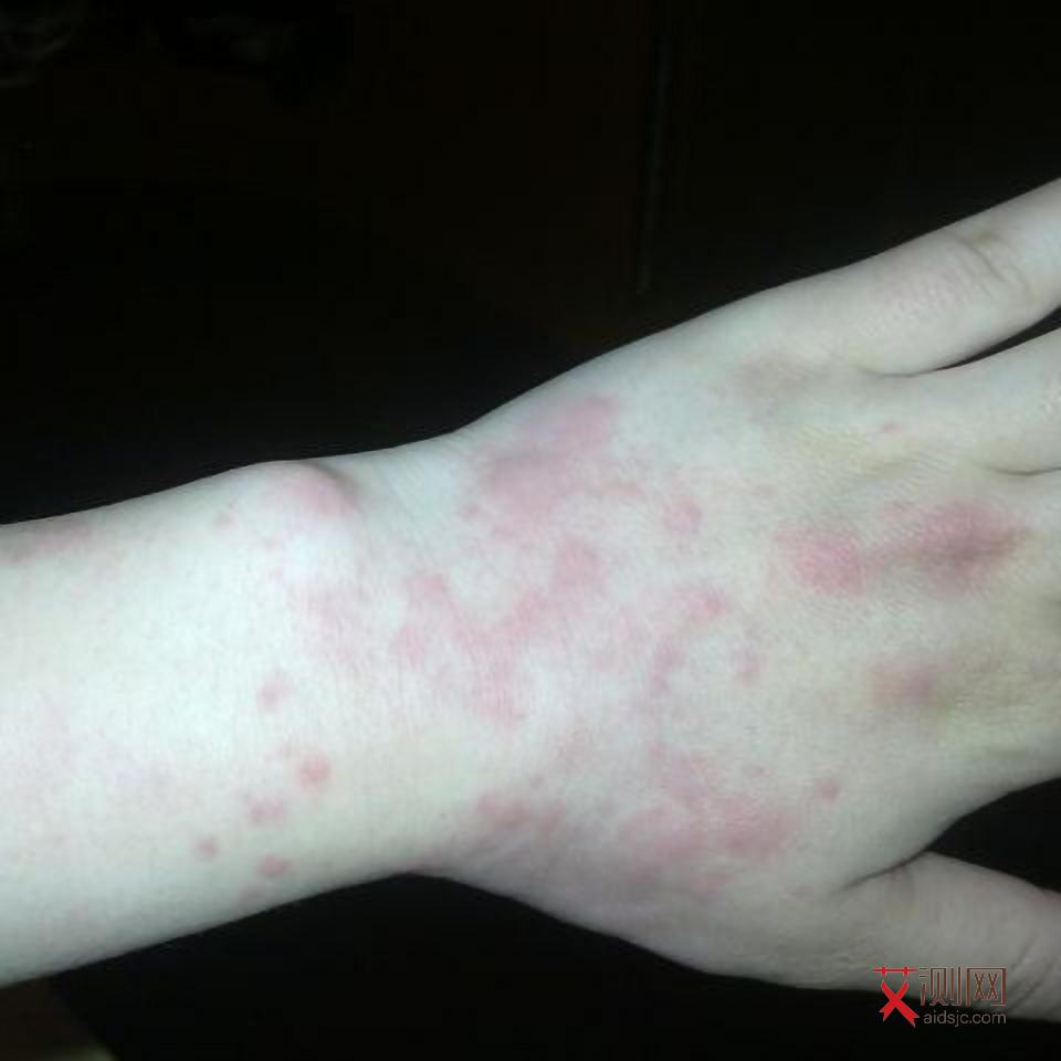 艾滋病症状淋巴结肿大多久消失