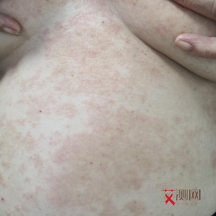 艾滋病的几种症状表现是什么样子图片大全